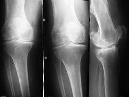 Рентгенография коленного сустава 